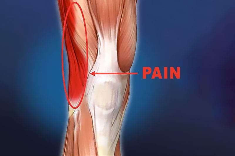 Knee Iliotibial Band Friction Syndrome After Total Knee